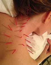 Dry Needling